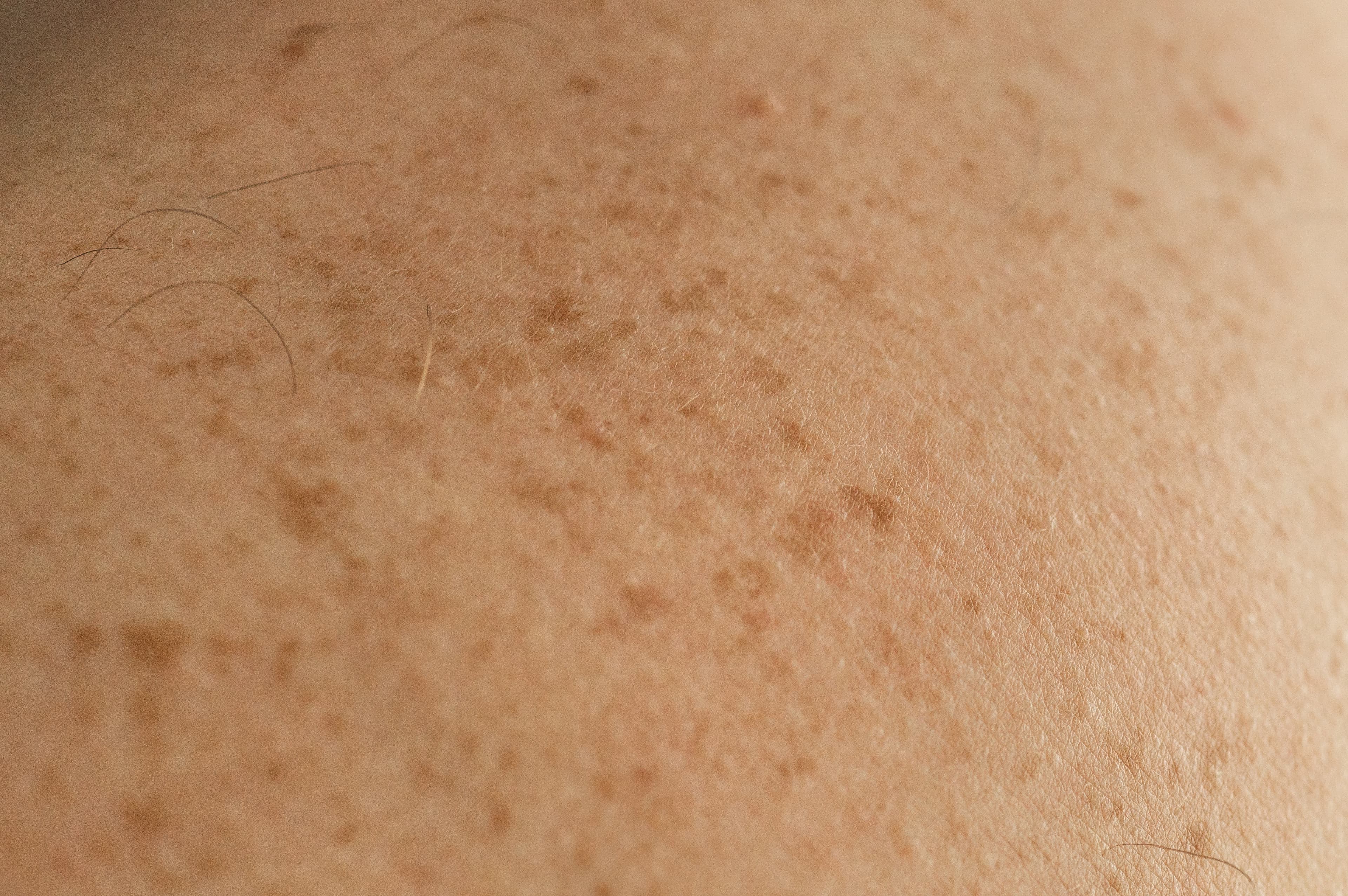 Skin discolouration — close-up
