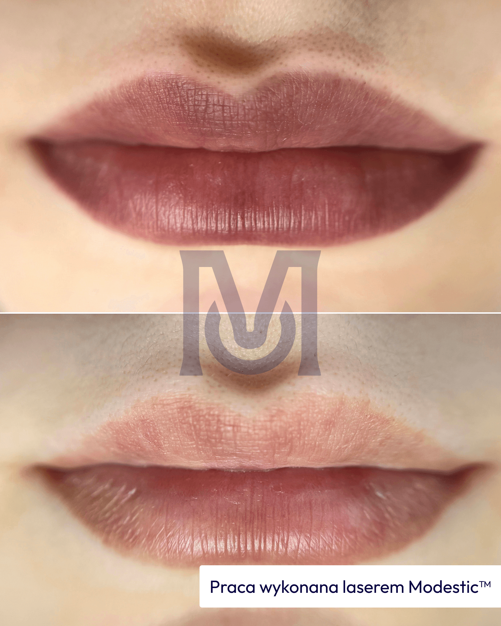 Modestic laser treatment result — lips before and after