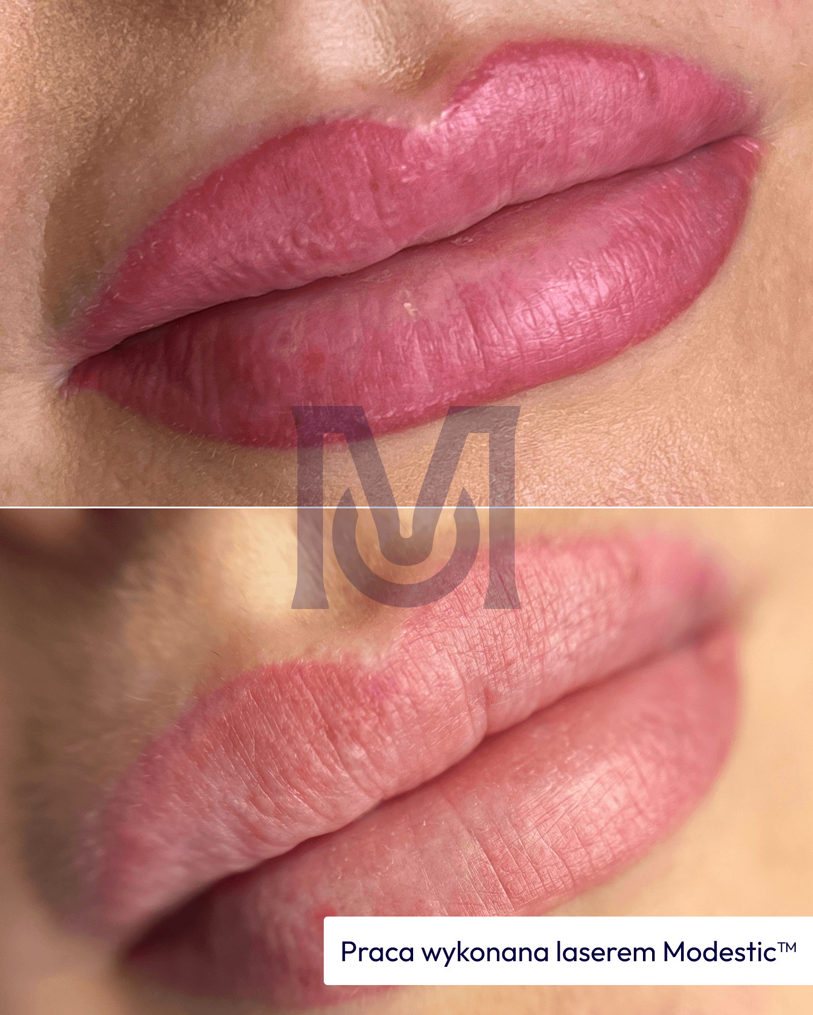 Modestic laser treatment result — lip lightening before and after