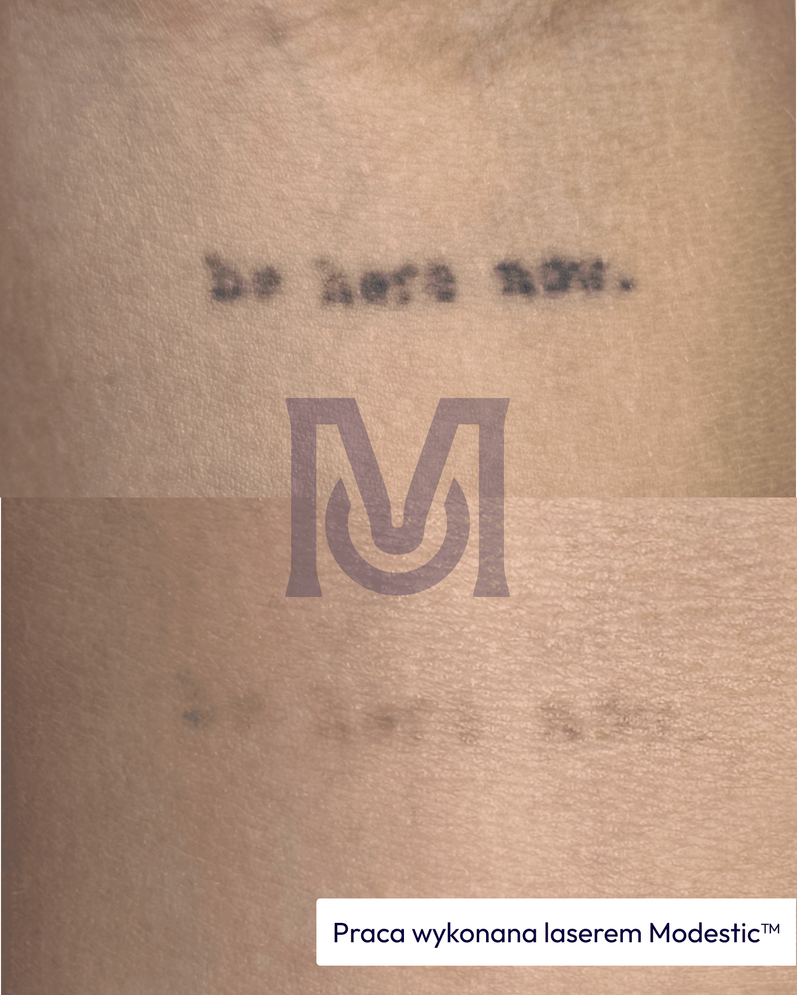 Tattoo removal with a Modestic laser — before and after