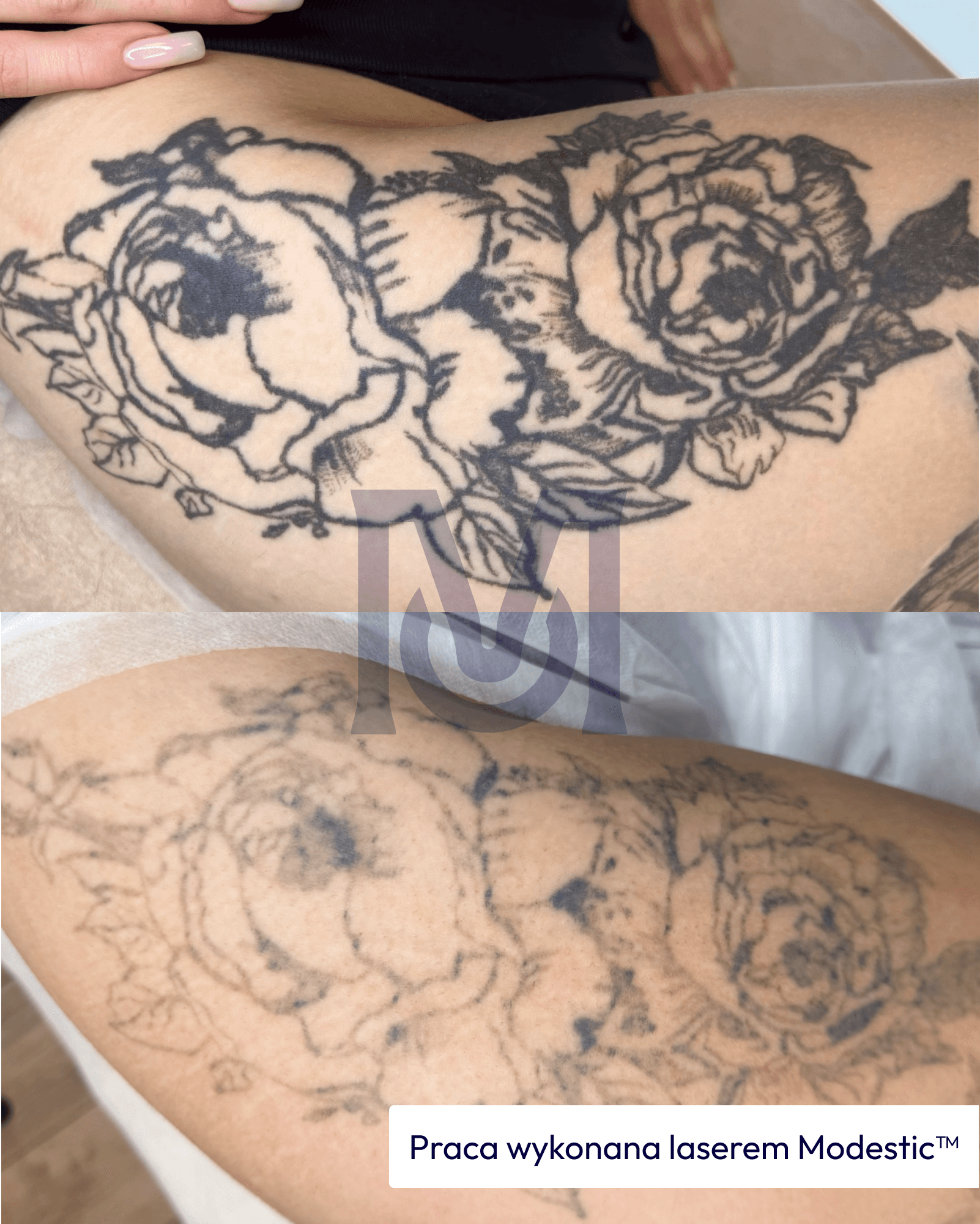 Tattoo removal with a Modestic laser — before and after