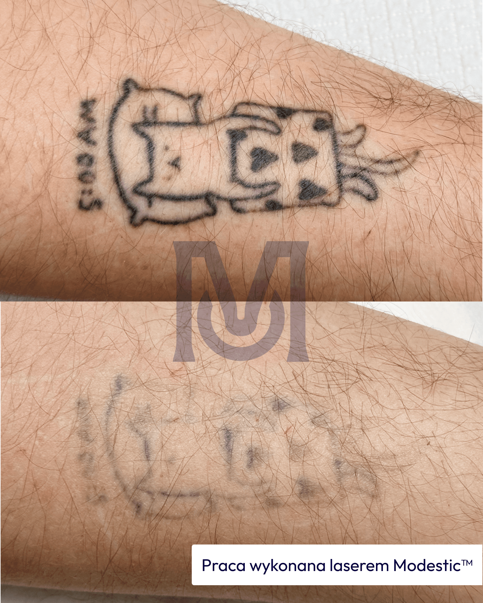 Tattoo lightening with a Modestic laser — before and after