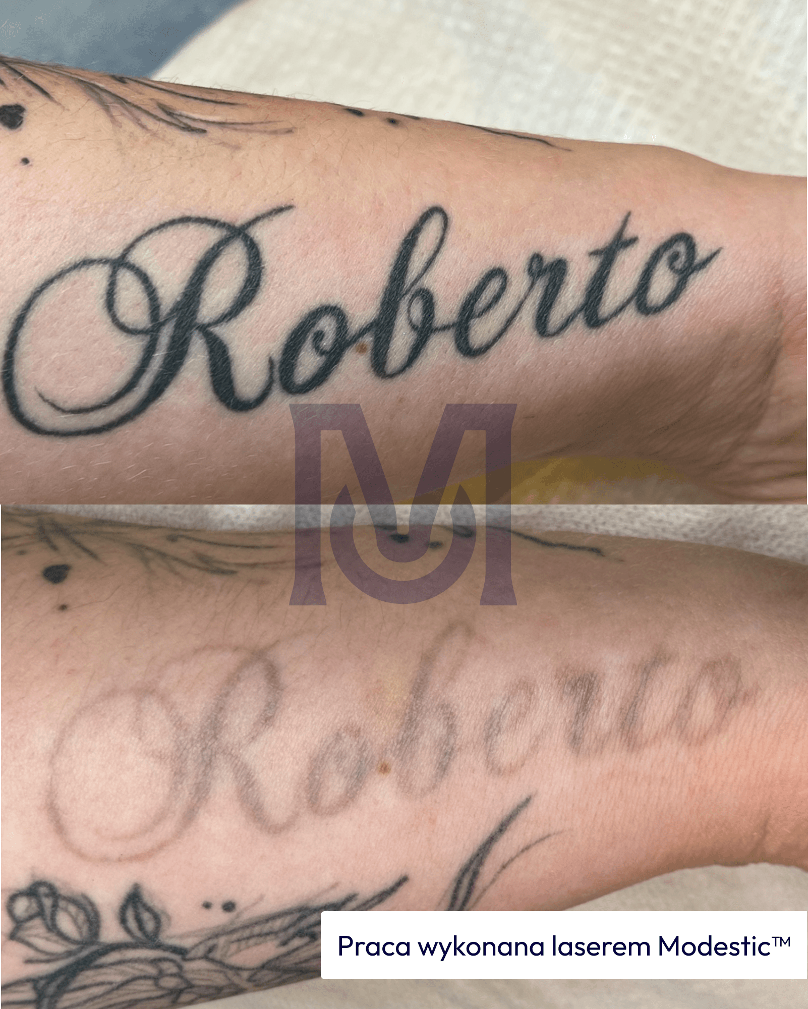 Tattoo removal with a Modestic laser — before and after