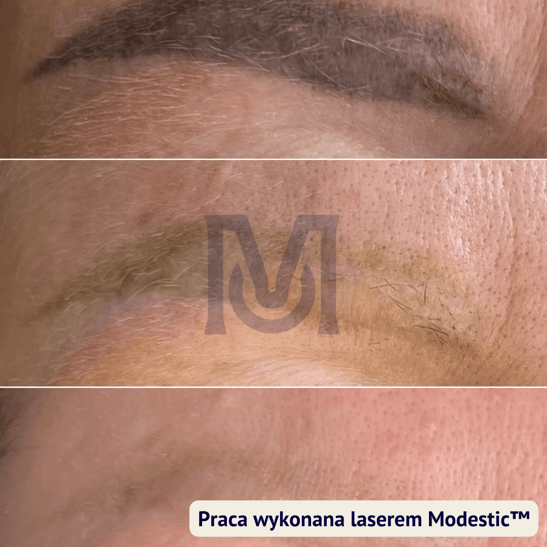 usuwanie makijażu permanentnego