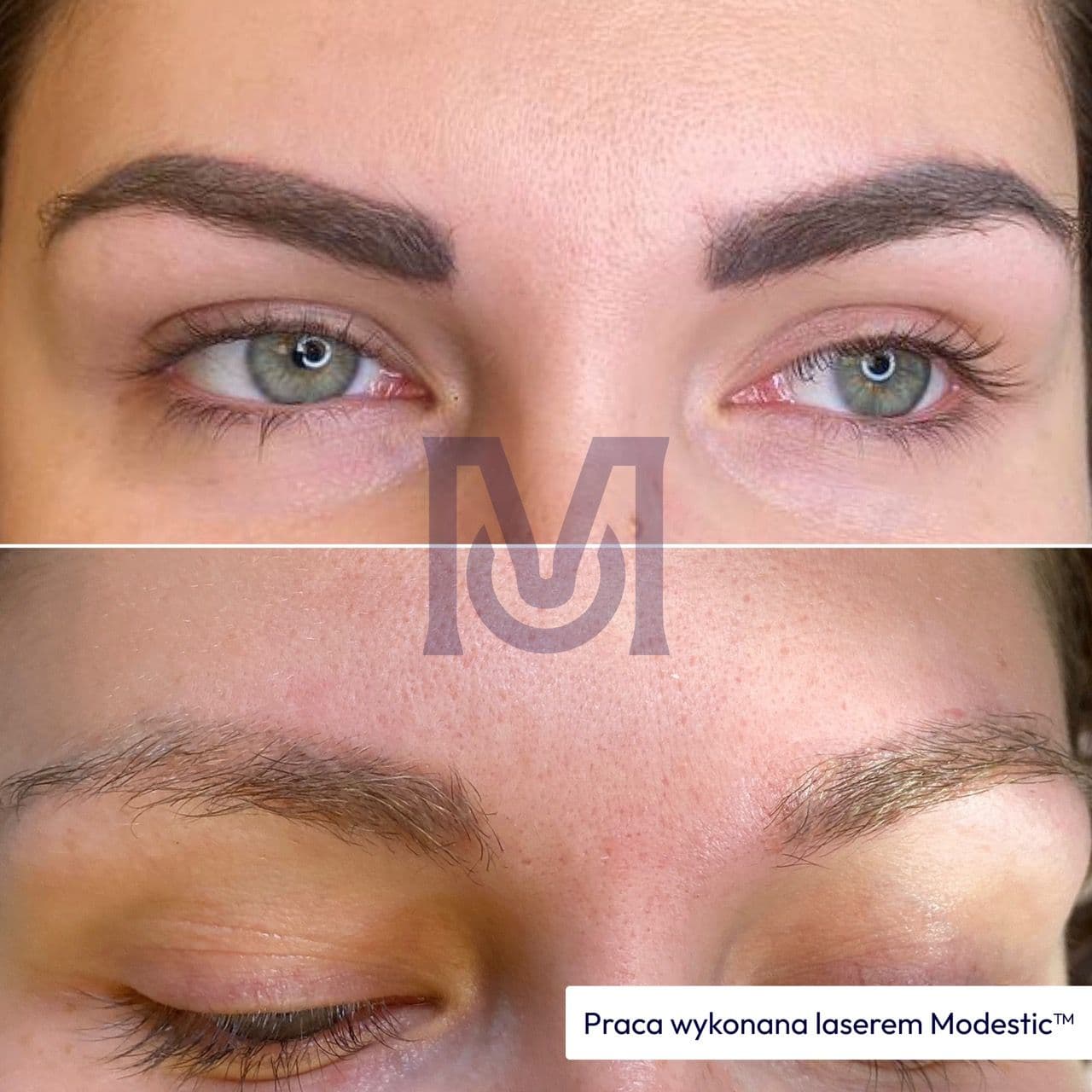 Masz stary laser do usuwania PMU? Zobacz efekty usuwania makijażu permanentnego nowym laserem (przed i po)